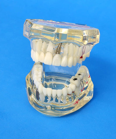 dental restoration veneer cosmetic model