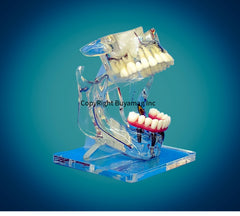  implants bridges crowns veneer restorative cosmetic dental models 