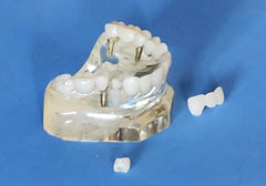 Dental Implants Crowns Bridge Restoration Cosmetic Model