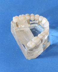 Dental Implants Crowns Bridge Restoration Cosmetic Model