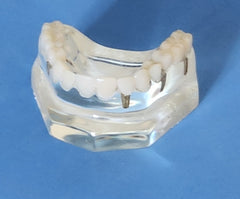 Dental Implants Crowns Bridge Restoration Cosmetic Model