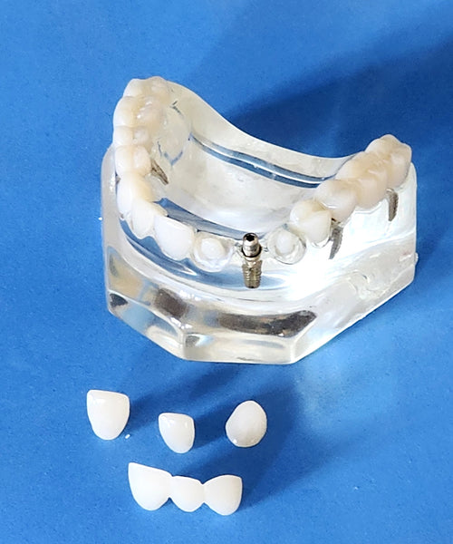 Dental Implants Crowns Bridge Restoration Cosmetic Model