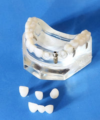 Dental Implants Crowns Bridge Restoration Cosmetic Model