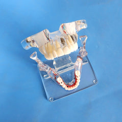 dental restoration model 