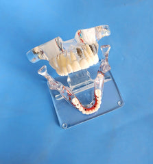 restoration dental implant model