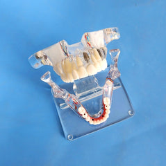 dental sinuses lift restoration implants bridges model