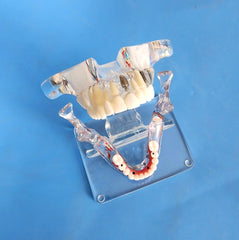 dental restoration implants bridges model