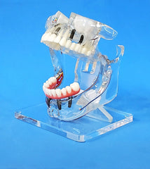 dental cosmetic restoration model