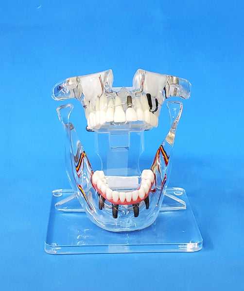 implant sinuses bridge dental model