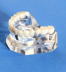 Dental Implants Model Bridge Crowns Veneer Clear Base Maxillary Restoration Cosmetic