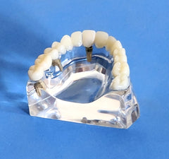 Dental Implants Model Bridge Crowns Veneer Clear Base Restoration Cosmetic