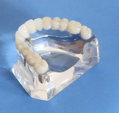 Dental Implants Model Bridge Crowns Veneer Clear Base Restoration Cosmetic