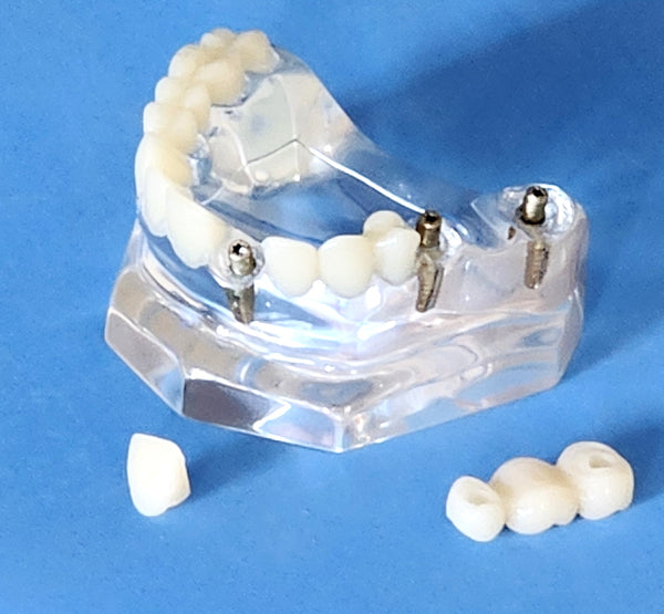 Dental Implants Model Bridge Crowns Veneer Clear Base Maxillary Restoration Cosmetic