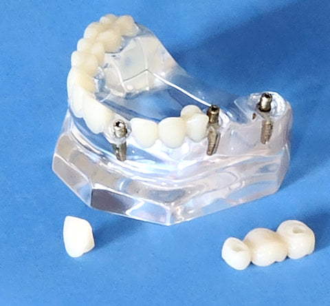 Dental Implants Model Bridge Crowns Veneer Clear Base Maxillary Restoration Cosmetic