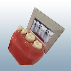 interproximal caries x-ray model