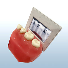 Interproximal x-ray Caries model