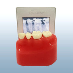 Interproximal Caries x-ray model