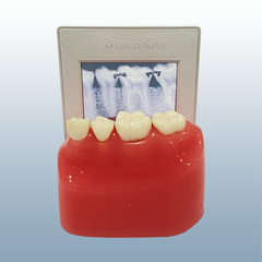 interproximal caries x-ray modes