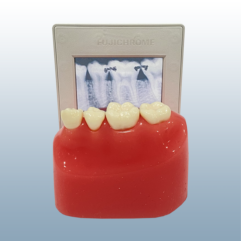 dental interproximilar caries x-ray model