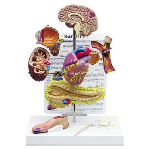 diabetes disease model