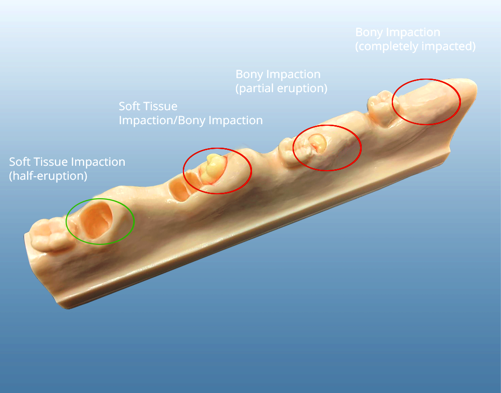Impacted Eruption Tooth Extraction Model - Suture Buyamag – Buyamag INC