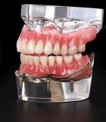Over Denture Dental Model 4 Implants Locator Partial