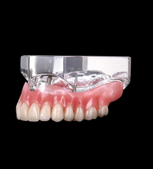 4 Implants Locator Overdenture Model