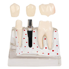 Dental Implant Crown Bridge Restoration Model Patient Demonstration 3 Unit Bridge Two Premolars Removable Crown