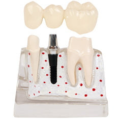 Dental Implant Crown Bridge Restoration Model Patient Demonstration 3 Unit Bridge Two Premolars Removable Crown