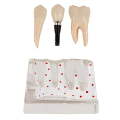 Dental Implant Crown Bridge Restoration Model Patient Demonstration 3 Unit Bridge Two Premolars Removable Crown