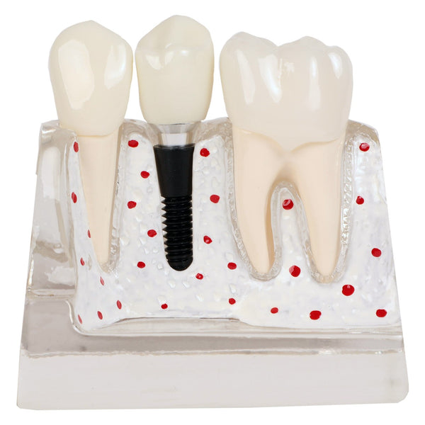 dental implant crown bridge model 