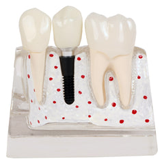 dental implant crown bridge model 