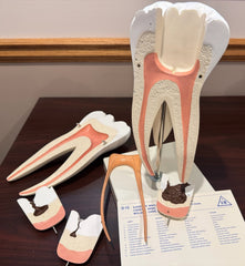 giant molar model with teeth cavities pulp