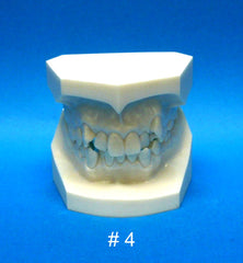  Malocclusion orthodontic model 