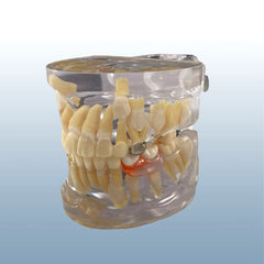 pre-eruption Space maintainer orthodontic model retainer