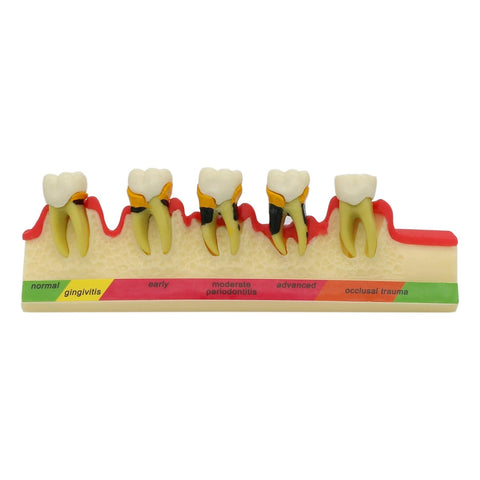 periodontal disease model
