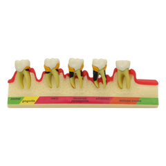 periodontal disease model