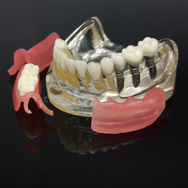 Dental Prosthetic Partial Model- Implant : Buyamag – Buyamag INC
