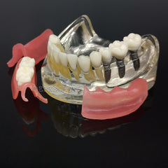 prosthetic implant bridge model