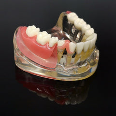 cosmetic prosthetic implant restoration  model