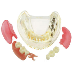 prosthetic patial reconstruction implant model