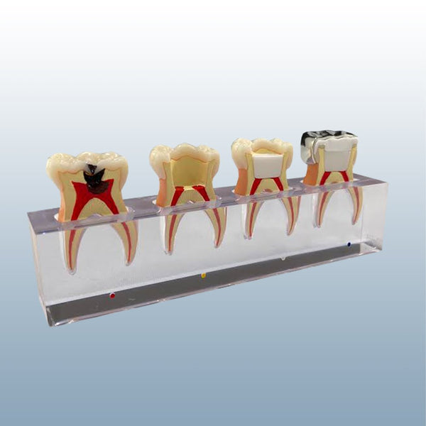 Pulpotomy Model- Molar Steel Crown Buyamag – Buyamag INC