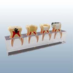 endodontic treatment model