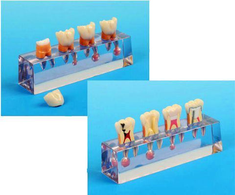 Endodontic Pulpotomy Sequence Treatment Molar Model Dental Education Teaching Practice