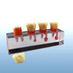 endodontic molars treatment pulpotomy