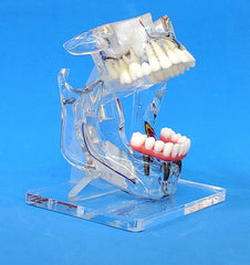 Dental reconstruction implants bridges veneer