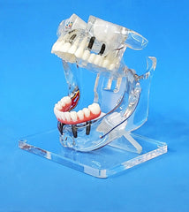sinus lift Dental implants bridges veneer model 