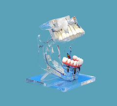 sinus lift implants bridges crown veneer  restoration model