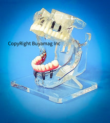 sinus lift implants bridges restoration model