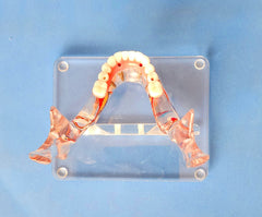 dental veneer bridge implant model 